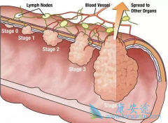 �����ʺ��о��쳣�ۺ����ǰ�ɳ����(Oxaliplatin)�ĺ���������