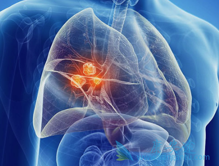 肺癌晚期症状 肺癌晚期症状