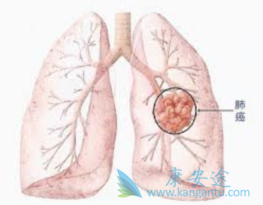 肺癌晚期传染吗 肺癌晚期传染吗