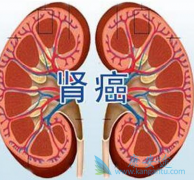 �ַ�����(lenvatinib)������ת���������Ϻ���Ǳ��