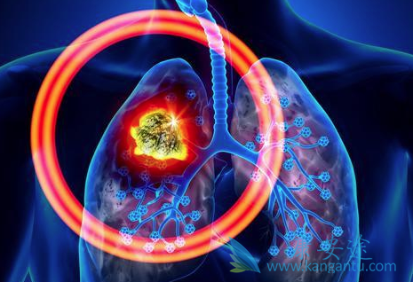 肺癌晚期可以治好吗 肺癌晚期可以治好吗
