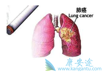 肺癌晚期可以治好吗 肺癌晚期可以治好吗