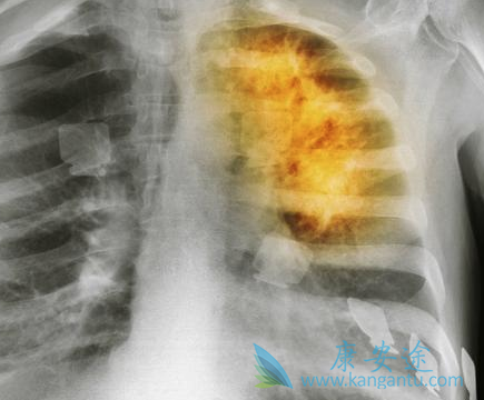 肺癌晚期还有救吗 肺癌晚期还有救吗