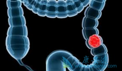 ���ᵥ��(Panitumumab)��KRASҰ����ת���Խ᳦����һ����ҩ