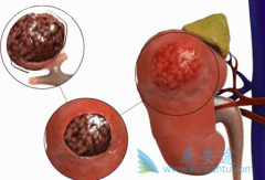 ��������(Cabozantinib)�ǿ�����������������������ڵ�ҩ��