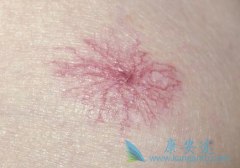 ʲô�Ǳ����ٴ�֢״�����˱�����ô��