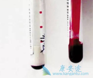 丙肝能治愈吗 丙肝能治愈吗