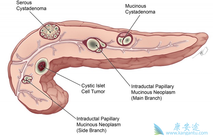 胰腺癌治疗 胰腺癌治疗