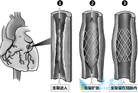 心脏支架手术 心脏支架手术