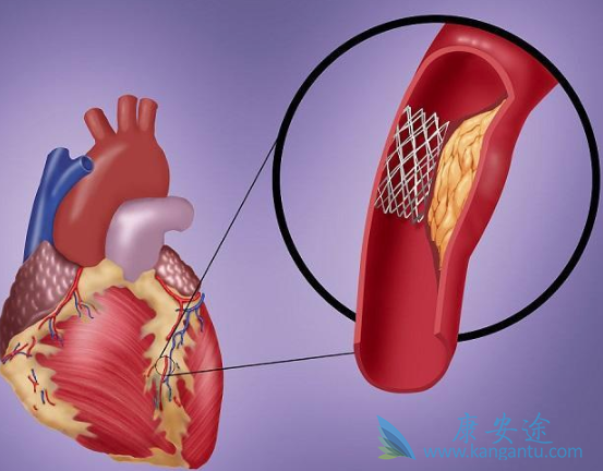 心脏支架手术 心脏支架手术