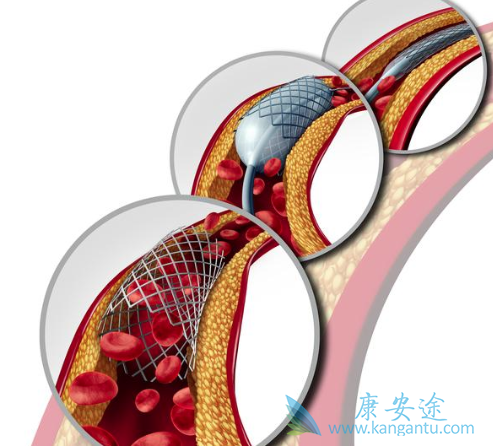心脏支架手术后 心脏支架手术后