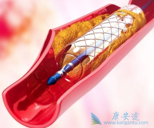 心脏支架手术后 心脏支架手术后