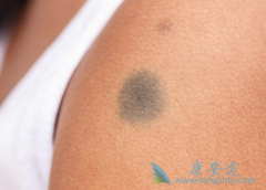 �˽���ЩƤ����֢״���Ա��Ⱙ֢����