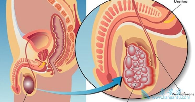 睾丸癌症状 睾丸癌症状