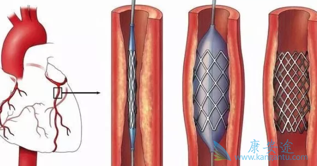 心脏支架多少钱 心脏支架多少钱