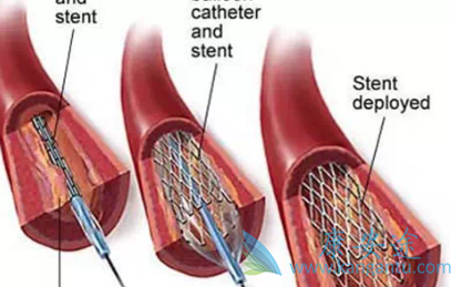心脏支架利与弊 心脏支架利与弊