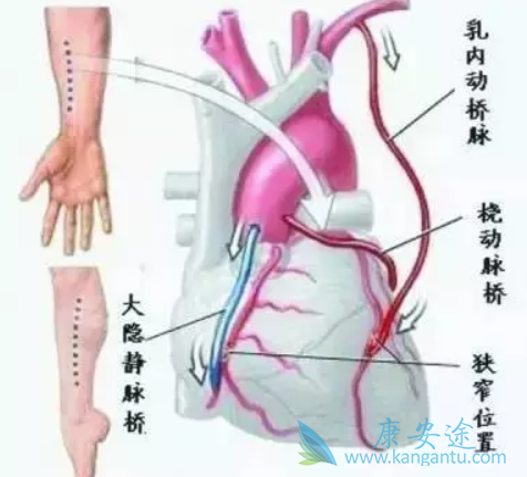 心脏支架和搭桥的区别 心脏支架和搭桥的区别