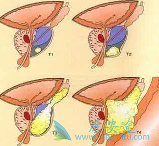 阿比特龙 阿比特龙