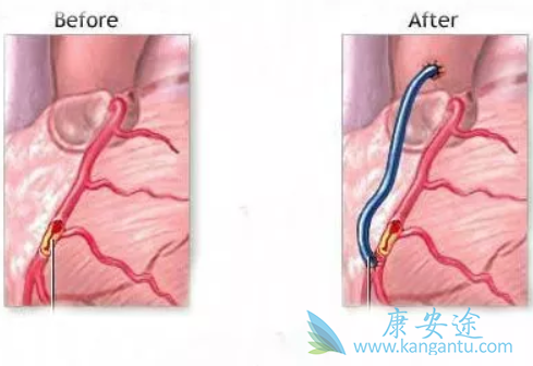 心脏支架和搭桥的区别 心脏支架和搭桥的区别