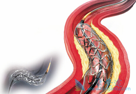 心脏支架手术后注意事项 心脏支架手术后注意事项