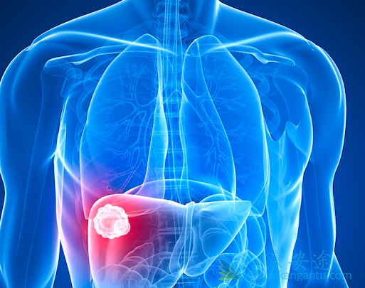 晚期肝细胞癌 晚期肝细胞癌