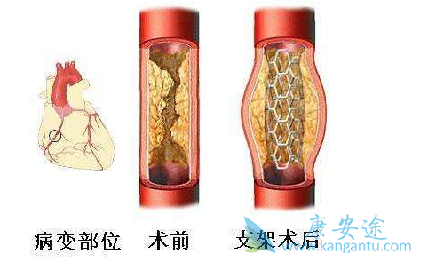 心脏支架手术后注意事项 心脏支架手术后注意事项