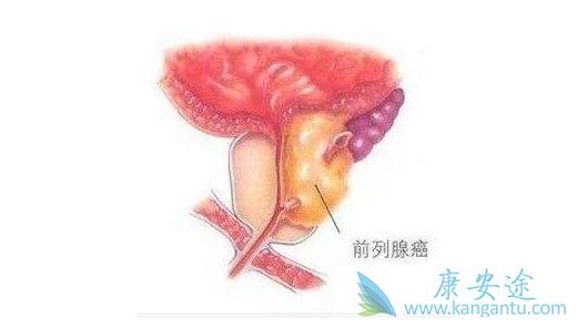 前列腺癌症 前列腺癌症