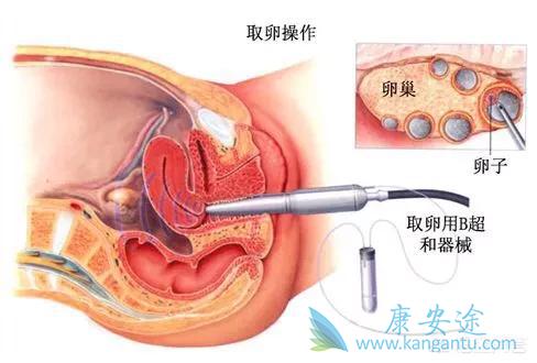 试管婴儿移植后几天着床 试管婴儿移植后几天着床