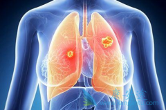 ��������(GILOTRIF)������޿������˸��õ��޽�չ������