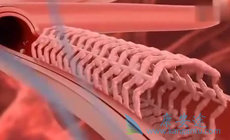 心脏支架 心脏支架