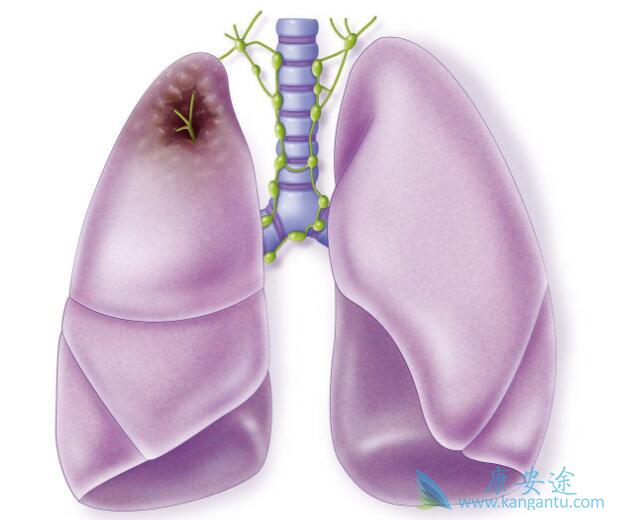 转移性肺癌 转移性肺癌