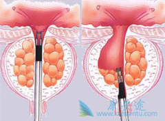 ��֢ҩ��Xtandi���н���ǰ���ٰ�֢ת�Ʒ��յ�����