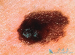 Ƥ�����ж��������ͣ�������Ƥ����֢״��ʲô���