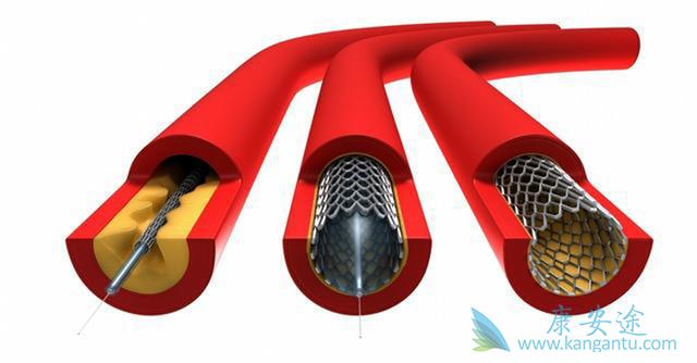 心脏支架 心脏支架