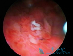 PD-L1����Atezolizumab���ư��װ��Ŀ͹���Ч��Ϊ14.8��