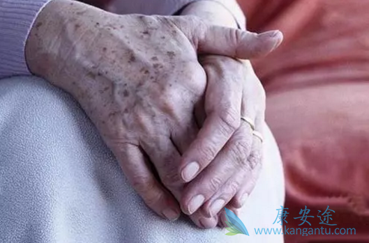 皮肤癌症的早期症状表现为出现不规则色素痣或黑斑