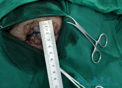 ����ϸ�������߷���Sonidegib����Ч�ӳ�������