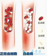 AHI-1�����ǵ��°�Ѫ�����߶�ӡ�ȸ�������Ӧ�����Ҫԭ��