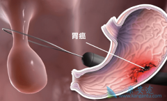 ��������Ƭ(Capecitabine)��������θ��������ٴ���Ч