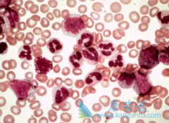 ΪʲôӢ��NICE��������������(nilotinib)���ڶ���CML����