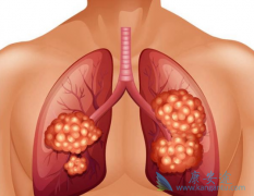 �ΰ�ҩ�ﰢ������(GILOTRIF)�����ڷ��۰���������