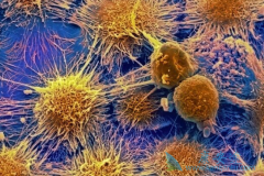 PD-1���Ƽ�(Keytruda)��ʹPD-L1�߱���ķΰ��������ܻ�����ĥ