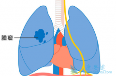 ������/���������뼪������һ��������EGFR��������ͻ������NSCLC