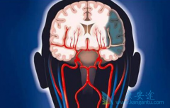 �������͵��԰����ɲ���ͷʹ­�ڸ�ѹ��������֢״