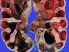 �������ڷ��ð���ҩ����������(sutent)���ܻ���