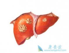 HBV��Ⱦ���������ΰ�����������֢�ķ��������й�