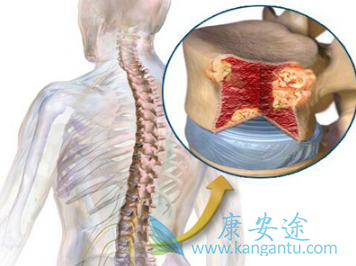 骨髓瘤症状 骨髓瘤症状
