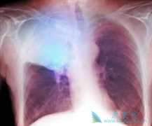 PD-1ҩ�����䵥��(Opdivo)��ʹ���ַΰ����߻�ó�������