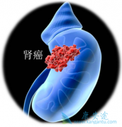 ��������(Sunitinib)���������������Ƶ���Чҩ����