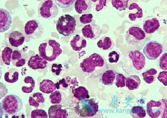 ��Ѫ�����߷�����������(Ponatinib)�ڼ�Ӧע����Щ����